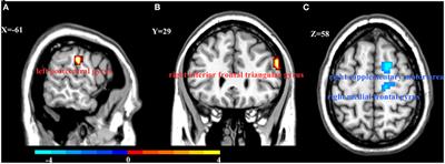 Changes in Regional Homogeneity of Medication-Free Major Depressive Disorder Patients With Different Onset Ages